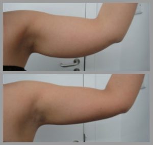 upper arm fat lipo before after photo