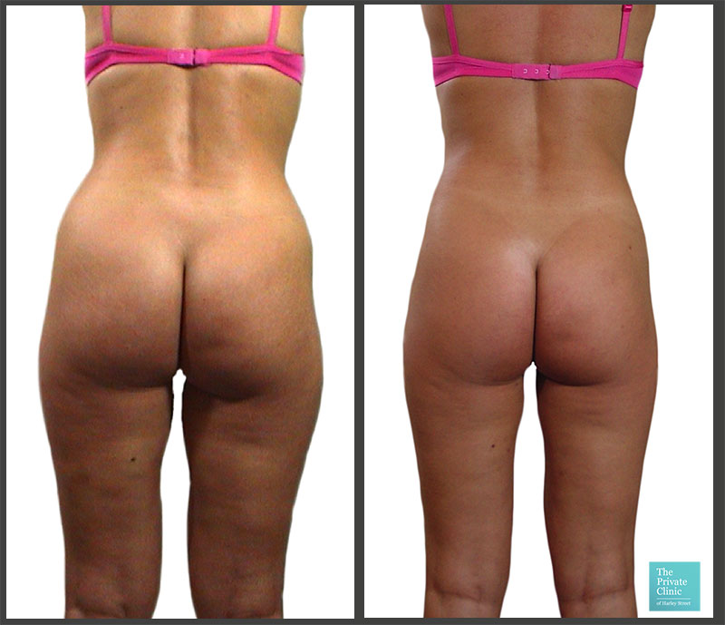 micro lipo buttock reshaping liposuction before after photos