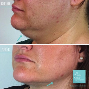micro lipo chin before after photo