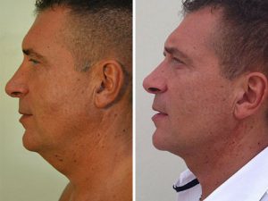 Micro Liposuction chin before and after photo