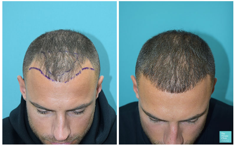 Mike Thurston 1year results before after FUE Hair Transplant 1700 grafts  Video Dr Raghu Reddy