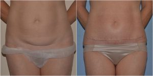 mini abdominoplasty before and after photos