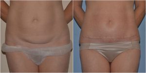 mini abdominoplasty before after photo
