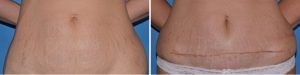 mini tummy tuck before after results