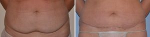 mini tummy tuck before and after photo UK