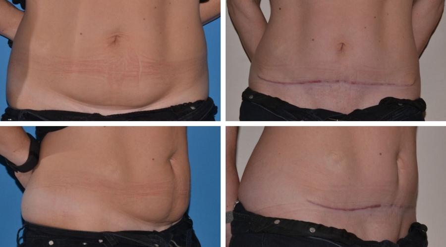 Mini Tummy Tuck vs. Full Tummy Tuck: Choosing the Right Procedure