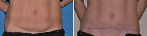 mini tummy tuck before after photo