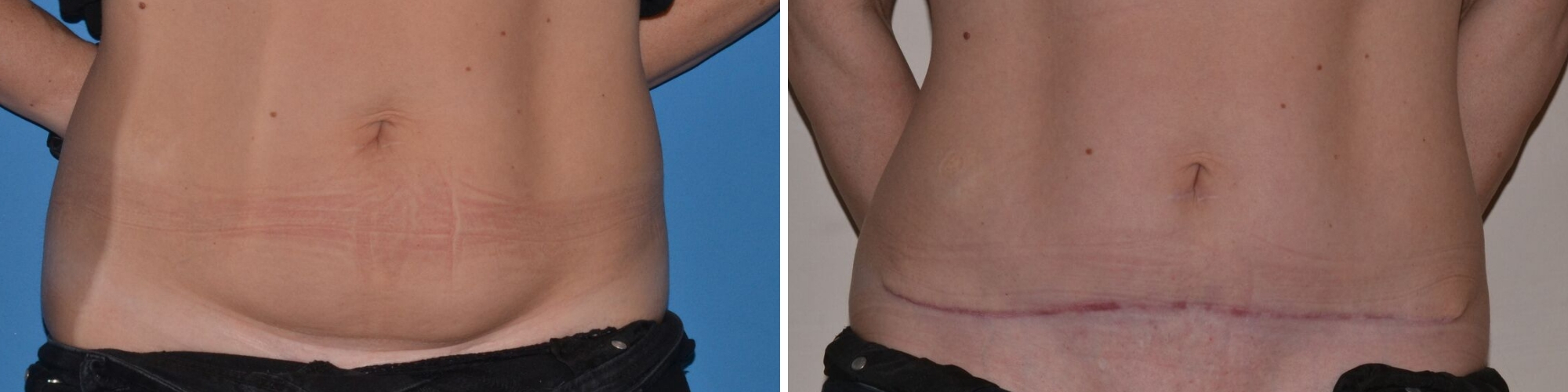 Tummy Tuck before and after UK, Mini Tummy Tuck London, Mini Abdominoplasty  UK