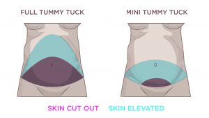mini abdominoplasty or full tummy tuck 