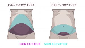 mini tummy tuck vs full tummy tuck