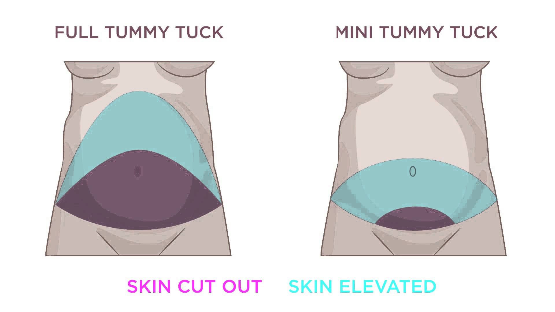 Difference Between a Full and Mini Tummy Tuck (Abdominoplasty)