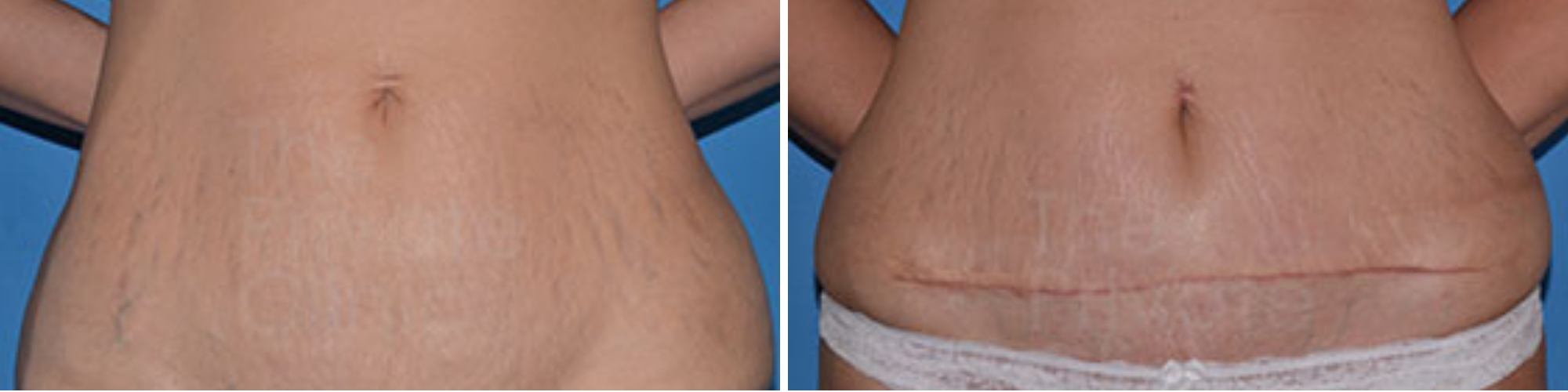 Tummy Tuck before and after UK Mini Tummy Tuck London Mini Abdominoplasty UK