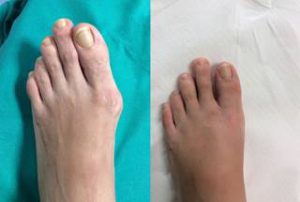 bunion surgery post op photo london before and after