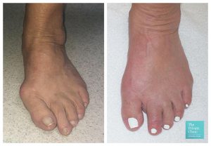 Minimally Invasive Bunion Removal Before and after photos