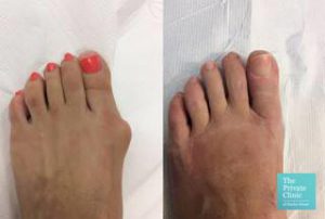 bunion surgery before after photos london harley street