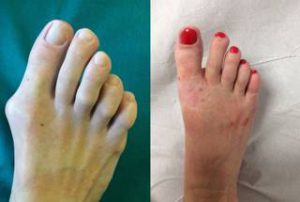 minimally invasive bunion removal treatment before after photos