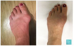 bunion surgery london before after photo