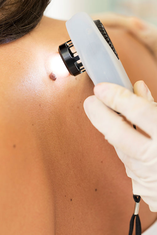 mole-removal-the-private-clinic