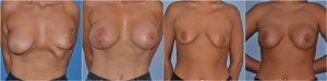 Asymmetry breast correction before after photos uk