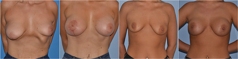  breast asymmetry correction before after photo