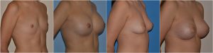 Breast Augmentation before after photo