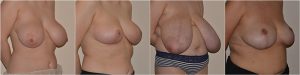 Breast Reduction before after photos UK