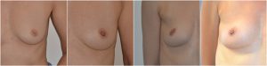 Inverted Nipple Correction before after photos uk