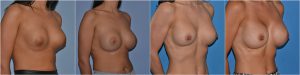 Breast Implant Replacement before after photos uk