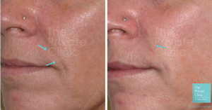 Before and after Nasolabial folds photo