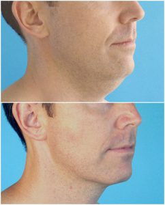 neck lipo men double chin before after photo