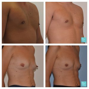 nipple reduction male female before after photos results