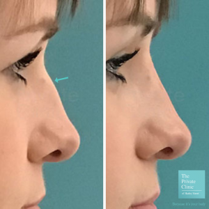 non-surgical nose job before and after photo