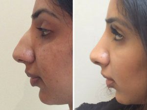 nose job before and after photo