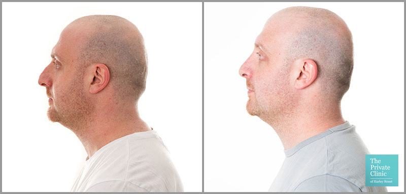 rhinoplasty london nose clinic harley street before after photo