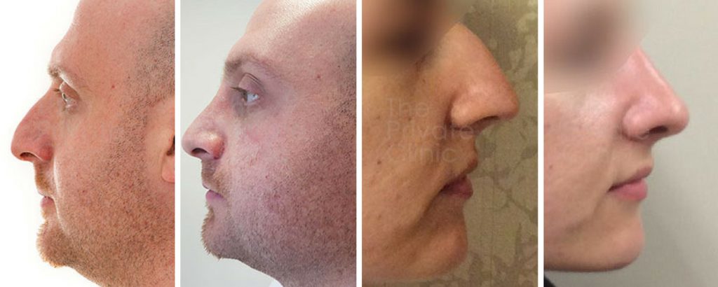 nose reshaping surgery before and after photos london