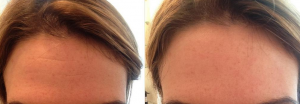 Before and after one application of notox serum. 