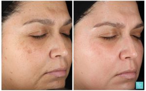 obagi-nu-derm-system-pigmentation-before-after-results-photos-300x186.jpg