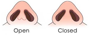 Open closed Rhinoplasty