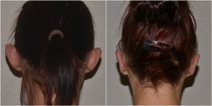 ear correction surgery before after photo