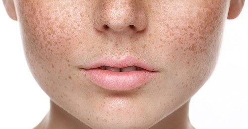 Skin Pigmentation Treatment