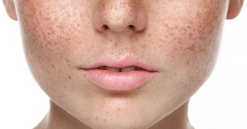 Pigmentation Treatment - luciemedispa.com