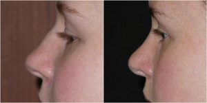 nose job rhinoplasty before after photo