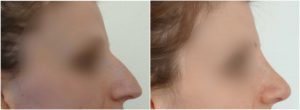 nose reshaping surgery before after photo