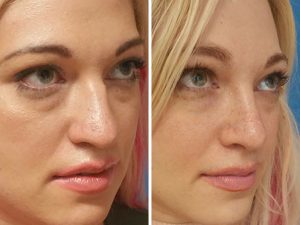 rhinoplasty before and after photos