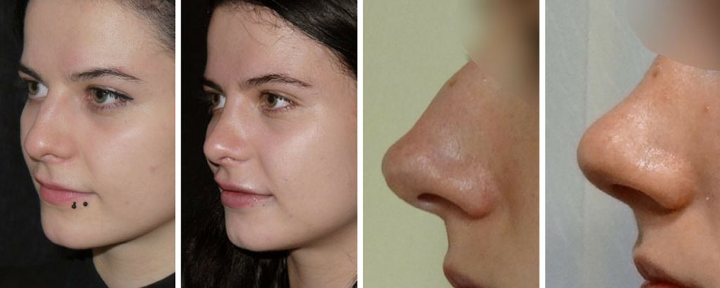 nose job surgery before and after the private clinic