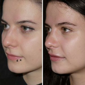 nose job rhinoplasty before and after photo