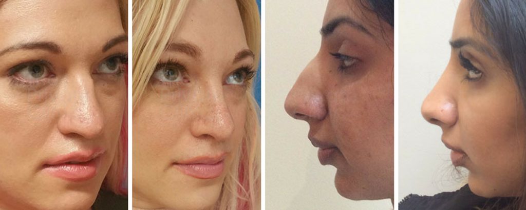 rhinoplasty before after photos results the private clinic