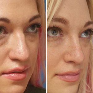 rhinoplasty surgery before after private clinic