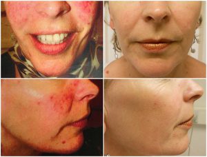 rosacea-ipl-before-after-the-private-clinic-web