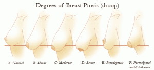 Breast lifts severe sagging in the breasts 